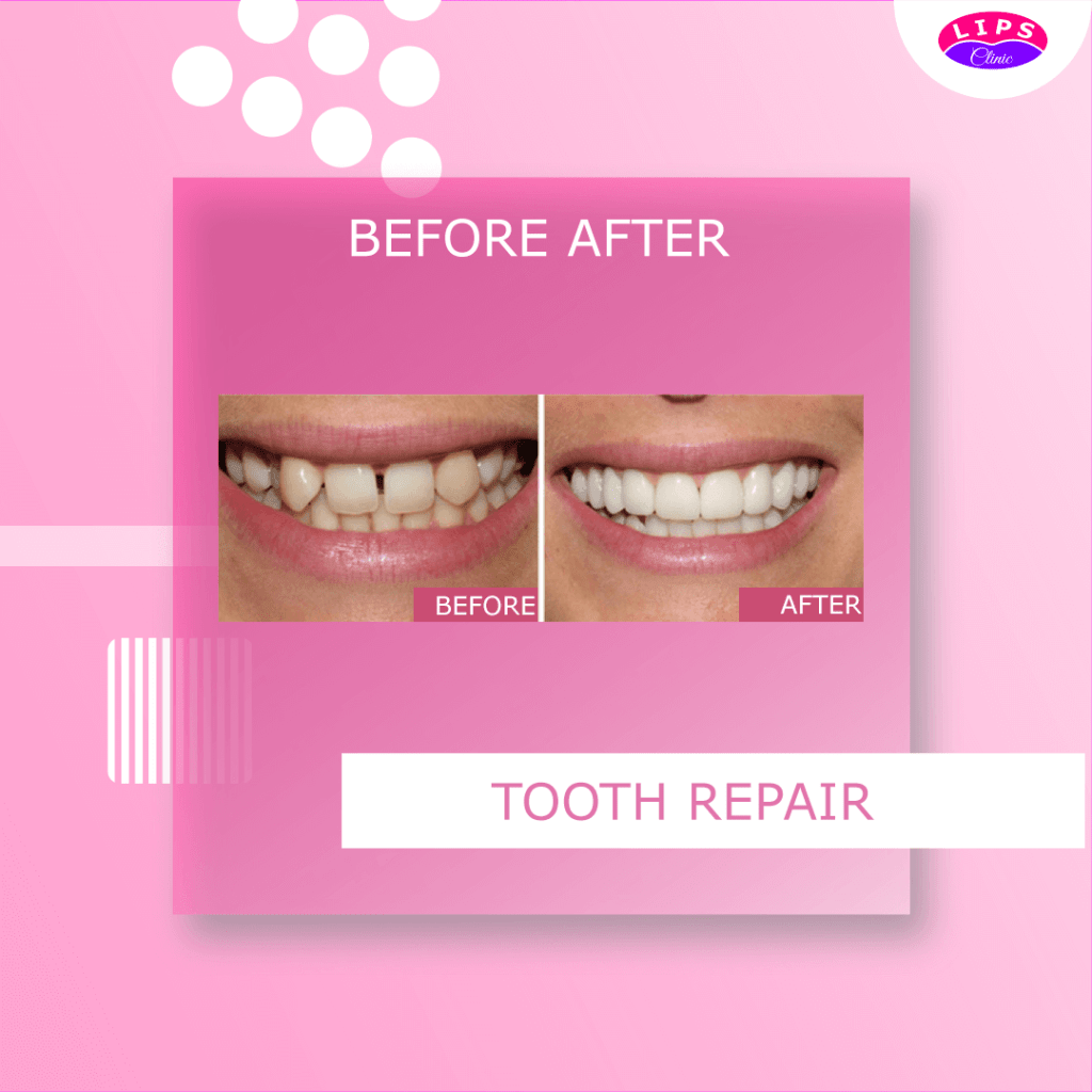Tooth-Repair
