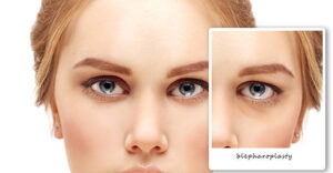 Blepharoplasty Terbaik