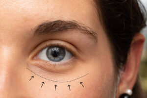 Blepharoplasty Jakarta