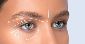 Blepharoplasty Jakarta