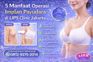 manfaat operasi implan payudara