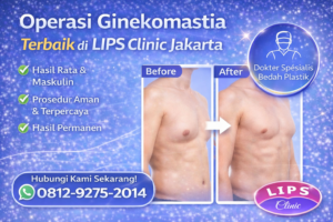 Operasi Ginekomastia Terbaik