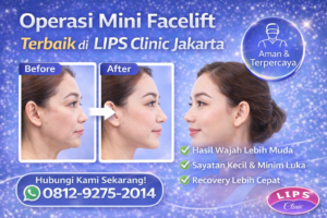 Operasi Mini Facelift Terbaik