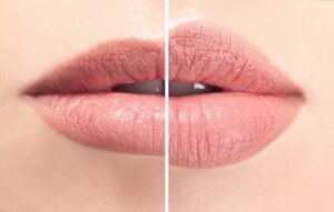 operasi bibir tebal jakarta hasil natural lips clinic